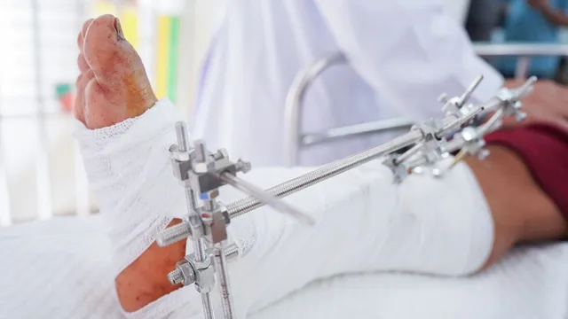 Nối thành công nhiều ca đứt lìa cổ bàn chân do máy cắt cỏ