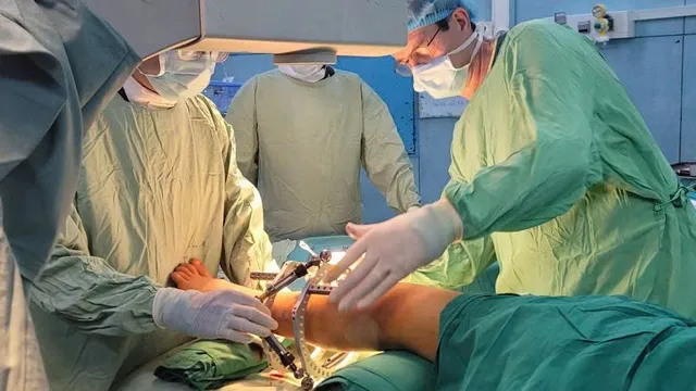 Phẫu thuật kéo dài chi cho trẻ thiểu sản xương mác