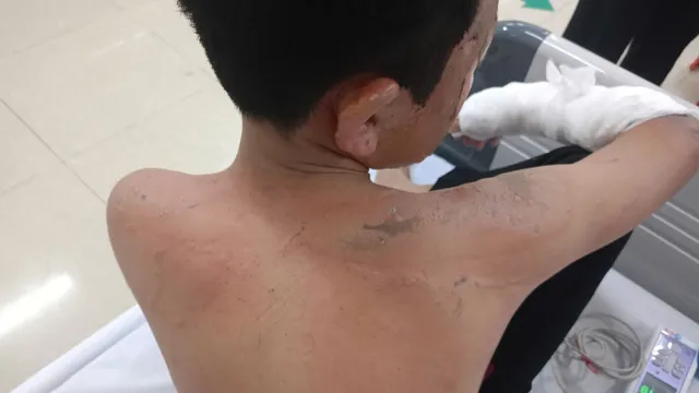 Trẻ bỏng nặng vì tự đốt pháo: Cảnh báo nguy hiểm dịp cận Tết