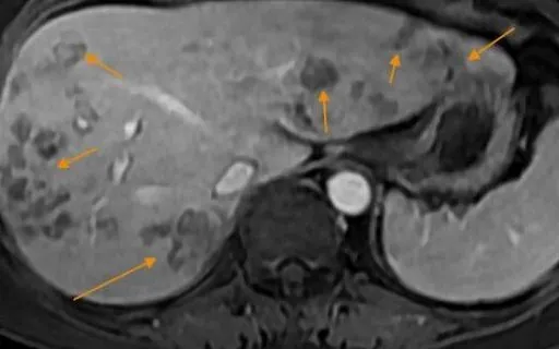 Ăn đồ tái, sống khiến bệnh nhân nhiễm sán lá gan lớn, tạo ổ áp xe 5cm