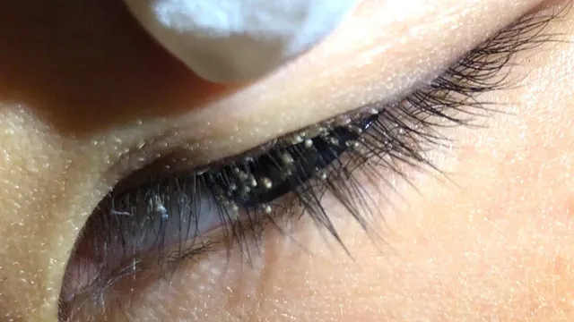 Phát hiện ổ ký sinh trùng ở mi mắt trẻ 5 tuổi