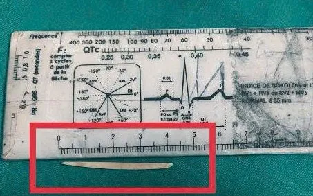 Đau bụng âm ỉ tưởng do ăn uống, nội soi phát hiện dị vật cắm sâu trong dạ dày