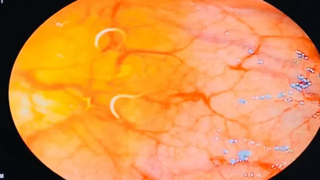 Rối loạn tiêu hóa kéo dài, đi khám phát hiện giun tóc ký sinh đại tràng