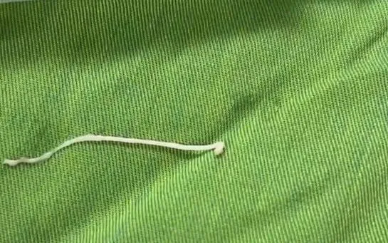 Hiếm gặp: Sán ký sinh trong khối u vùng ổ bụng