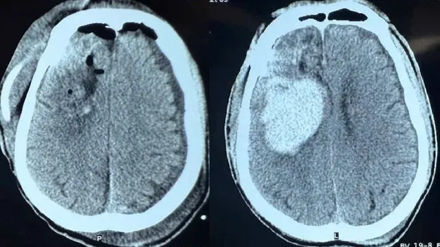 Ngã sau cơn động kinh, bệnh nhân xuất huyết não nguy kịch