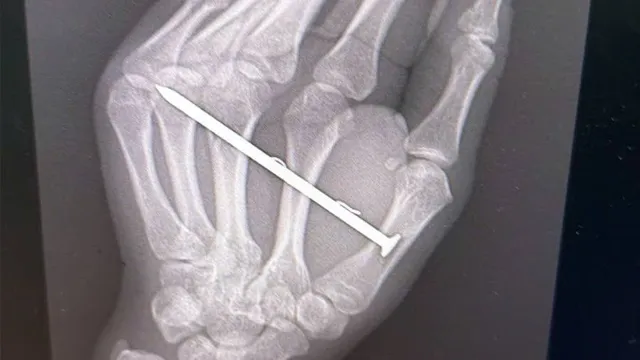 Cảnh báo tai nạn lao động nguy hiểm từ máy bắn đinh