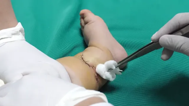 Phẫu thuật thành công ca "ngấn ối" hiếm gặp ở trẻ 10 tháng tuổi