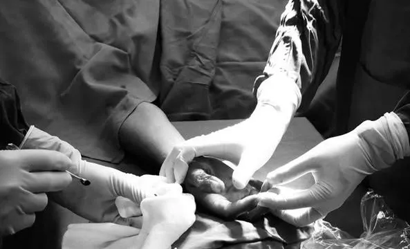 Điều trị thành công nhiễm trùng vết thương nặng bằng oxy cao áp