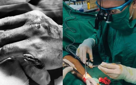 Vi phẫu nối thành công ngón tay cho bệnh nhân tai nạn lao động