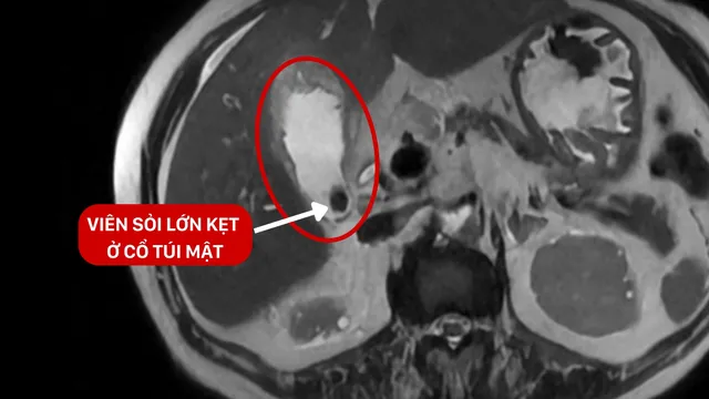 Sỏi mật 19mm khiến cụ bà 82 tuổi nhiễm khuẩn huyết