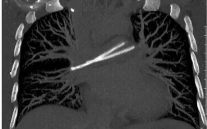 Dị vật "trôi" vào tim từ catheter để lâu năm