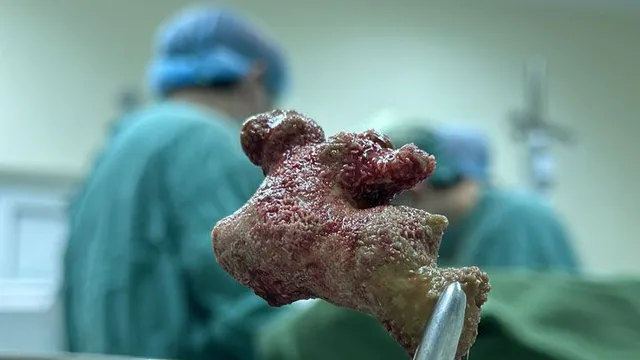 Đừng chủ quan với sỏi niệu quản