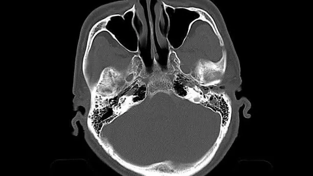 Ngã nhẹ ở người cao tuổi có thể gây chấn thương sọ não tử vong
