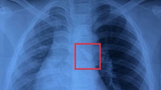 Gắp răng trong đường thở, cứu bé trai 10 tuổi sau tai nạn