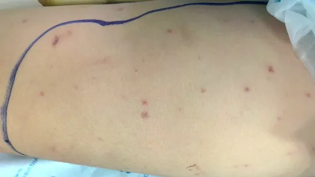 Những triệu chứng ban đầu dễ bị bỏ qua của bệnh do não mô cầu