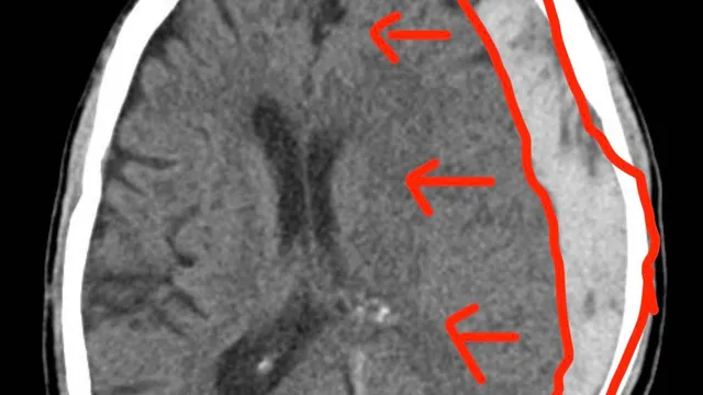 Cứu sống bệnh nhân tụ máu dưới màng cứng cấp tính