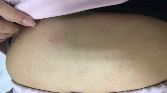 Nguy hiểm từ tự ý dùng thuốc, gia tăng ca sốc phản vệ