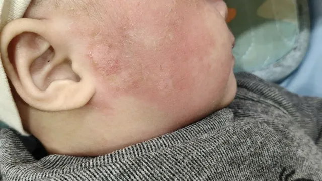 Đưa trẻ đi khám sớm khi có dấu hiệu bất thường về da