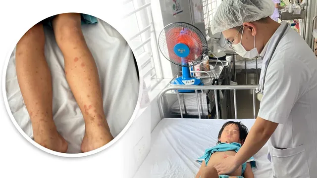 Infographic: Viêm mao mạch dị ứng ở trẻ em - Những điều cha mẹ cần biết