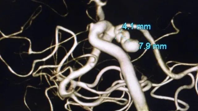 Đau đầu kéo dài, vào viện phát hiện khối phình mạch não kích thước lớn