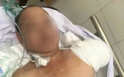 47 ngày không buông tay cứu bệnh nhân sốc nhiễm khuẩn nguy kịch