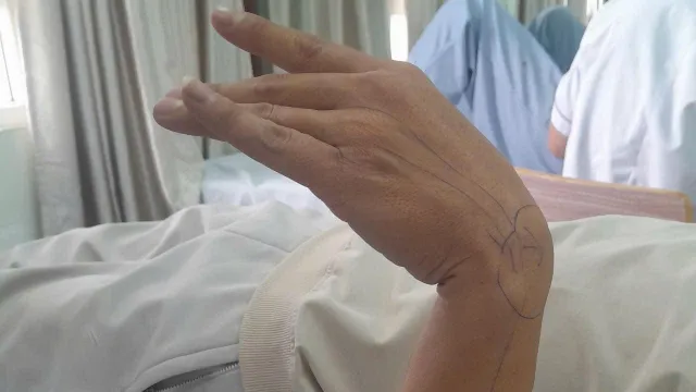 Liệt thần kinh quay do tư thế ngủ sai: Cảnh báo từ thói quen tưởng chừng vô hại