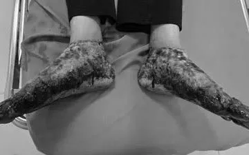 Ngâm chân nước lá đun nóng, người phụ nữ bỏng nặng hai bàn chân