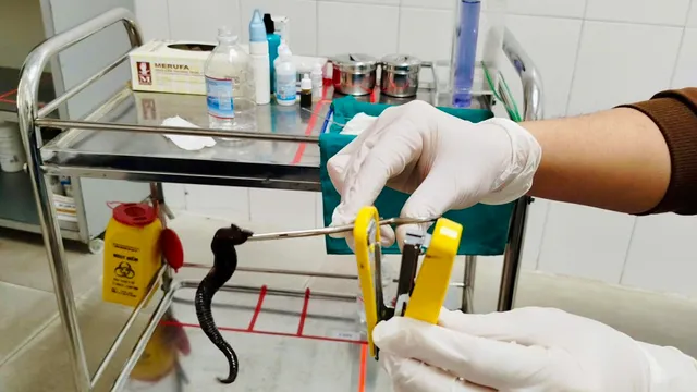 Phát hiện đỉa ký sinh trong mũi người bệnh