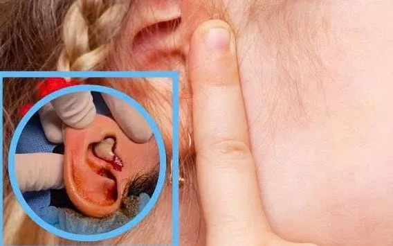 Nhọt ống tai ngoài có thể gây áp xe lan tỏa sau tai