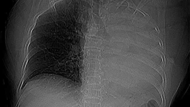 Xẹp toàn bộ phổi trái do dị vật đường thở