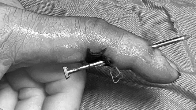 Tai nạn lao động nguy hiểm: Đinh dài 5cm xuyên ngón tay người phụ nữ