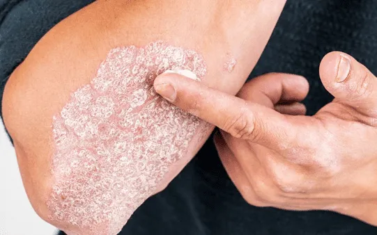 Chung sống lâu dài với bệnh vảy nến: Những điều người bệnh cần biết