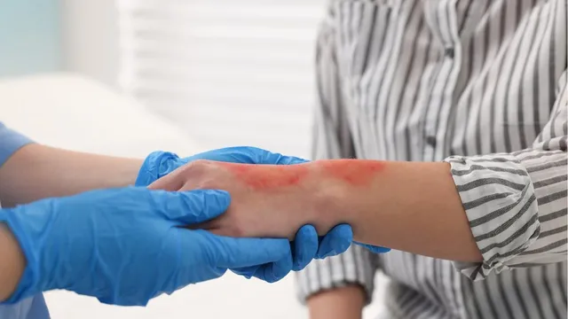 Bỏng - tai nạn thường gặp trong những ngày rét sâu