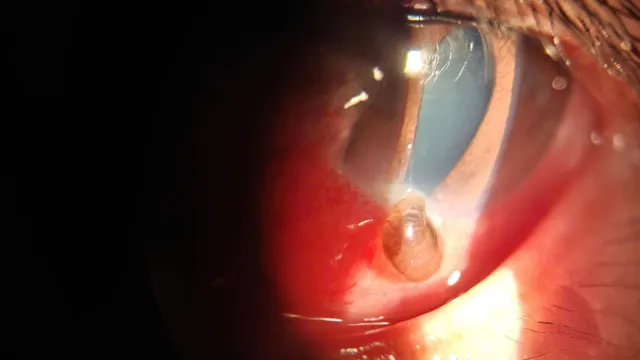 Chủ quan sau chấn thương, người bệnh đối mặt nguy cơ mất thị lực