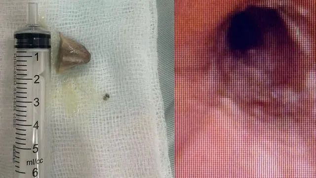 Kịp thời gắp xương lợn mắc kẹt trong phế quản người bệnh