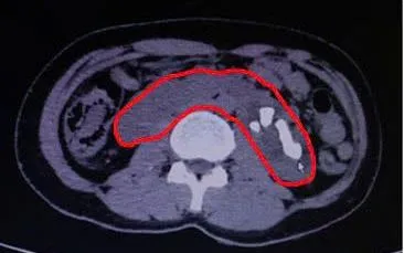 Tán sỏi qua da cho người bệnh dị dạng thận móng ngựa