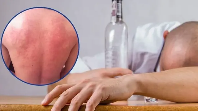 Uống rượu bia bị "mẩn ngứa, nóng bừng" - đừng chủ quan