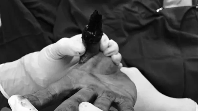 Giữ lại ngón tay trước nguy cơ cắt bỏ nhờ phẫu thuật tạo hình chuyên sâu