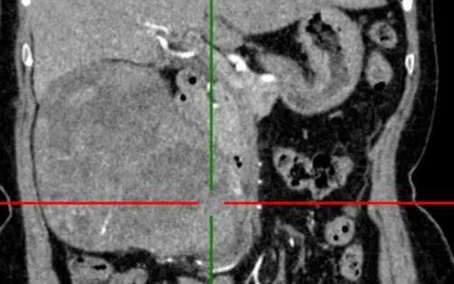 Đau âm ỉ lưng hông, vào viện phát hiện khối u thận lớn