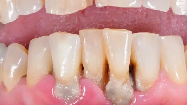 Bệnh nha chu - nguyên nhân hàng đầu gây mất răng ở người trưởng thành