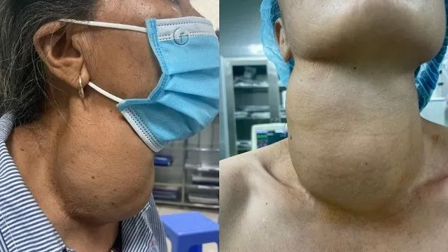 Phân biệt bướu cổ lành tính và ác tính qua các dấu hiệu cảnh báo