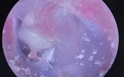 Chủ quan chưa mổ sớm cholesteatoma tai giữa, bệnh nhi 6 tuổi gặp biến chứng