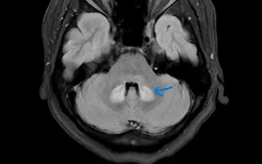 Thuốc lợi sữa không rõ nguồn gốc: Nguy cơ tổn thương não sau sinh
