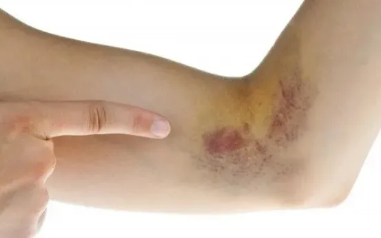 Ngày Thế giới Phòng, chống ung thư (4/2): Cảnh báo dấu hiệu ung thư ở trẻ em