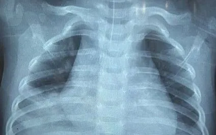 Trẻ 16 tháng suy hô hấp nguy kịch do uống nhầm dầu hỏa