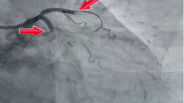 Phối hợp đa chuyên khoa cứu sống cụ bà 78 tuổi ngừng tim