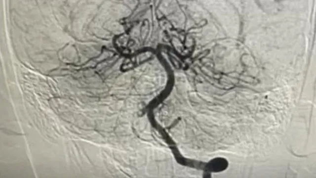 Bé trai 10 tuổi nhồi máu não khi đang chơi thể thao