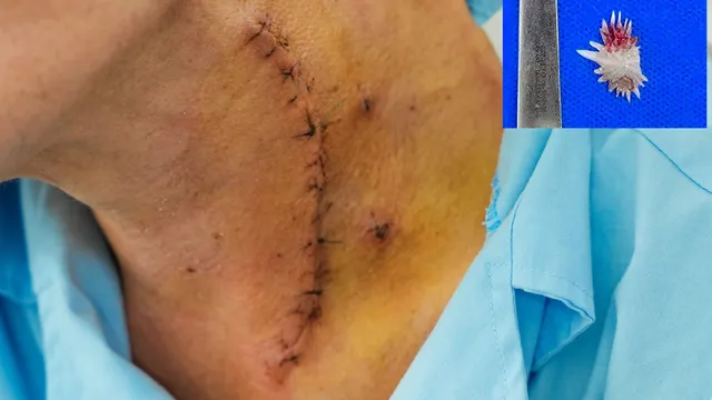 Cảnh báo nguy hiểm từ dị vật xương cá ở thực quản