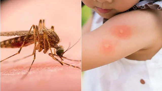 Du xuân an toàn: Xử trí thế nào khi bị côn trùng đốt?