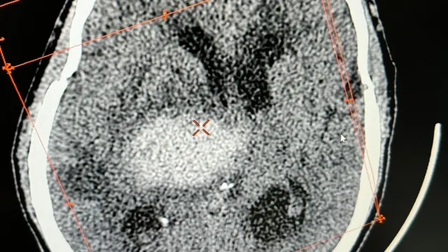 Xuất huyết não do tăng huyết áp không được phát hiện